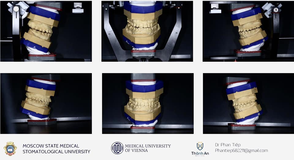 Niềng răng cải thiện sai lệch khớp cắn và mặt lệch như thế nào? - 3