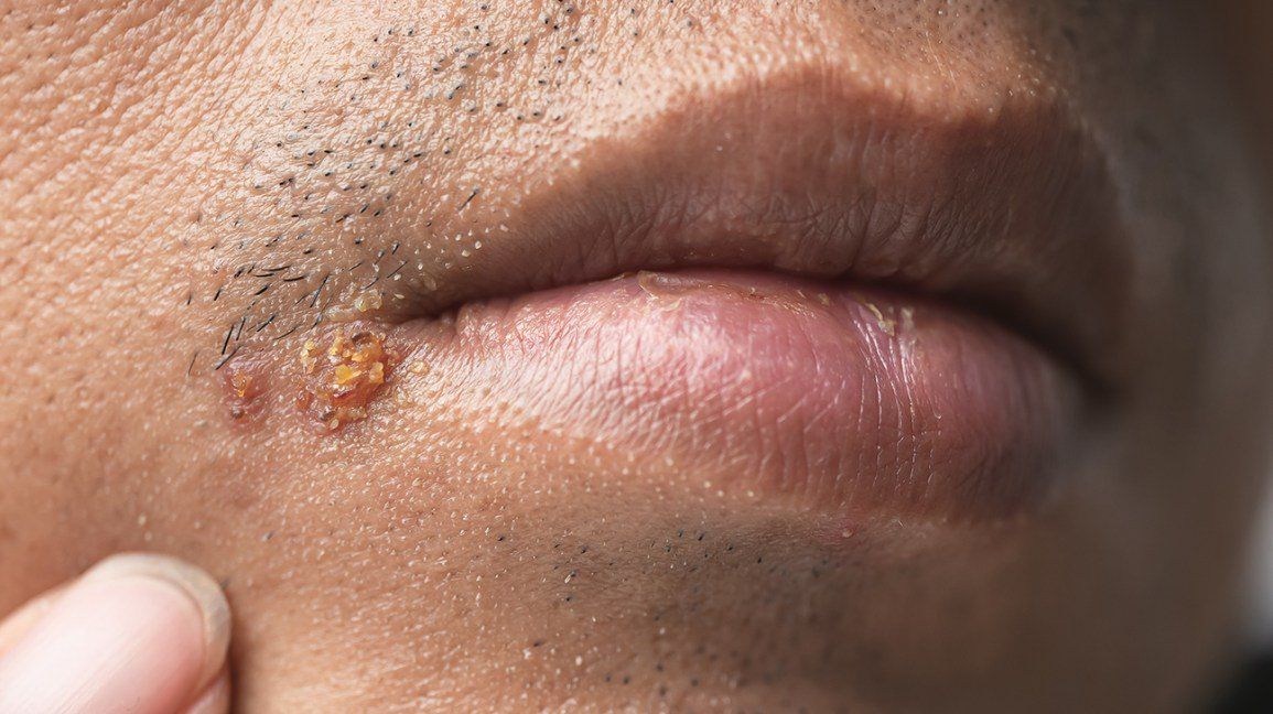 Quan hệ tình dục bằng miệng có thể dẫn tới mắc nhiều căn bệnh STDs. (Ảnh minh hoạ)