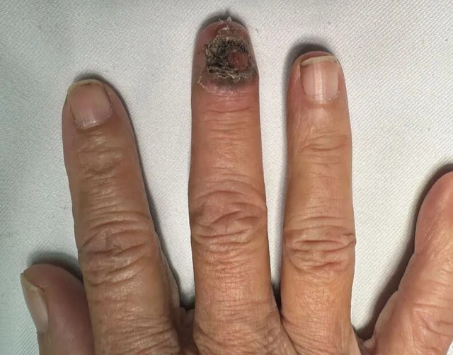 Tổn thương do ung thư da xuất hiện ở ngón tay