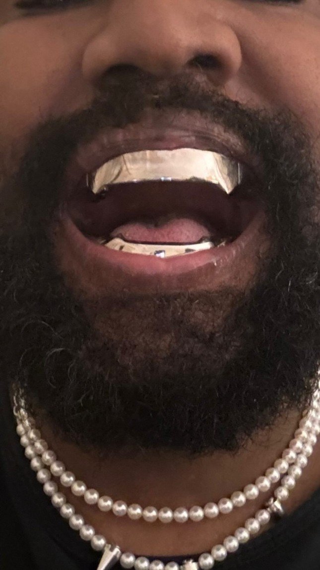 Gương mặt biến dạng của Kanye West sau khi nhổ hết răng - 1