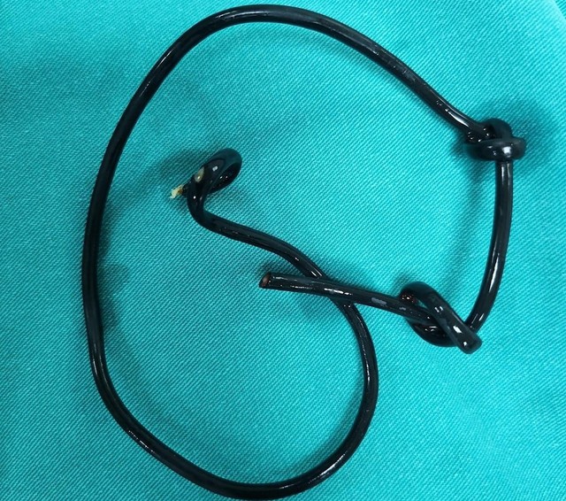 Đoạn dây điện được lấy ra từ niệu đạo của một bệnh nhân
