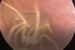 Phi thường - kỳ quặc - Clip: “Nổi gai ốc” cảnh nhện “tung tăng dạo chơi” trong tai người phụ nữ