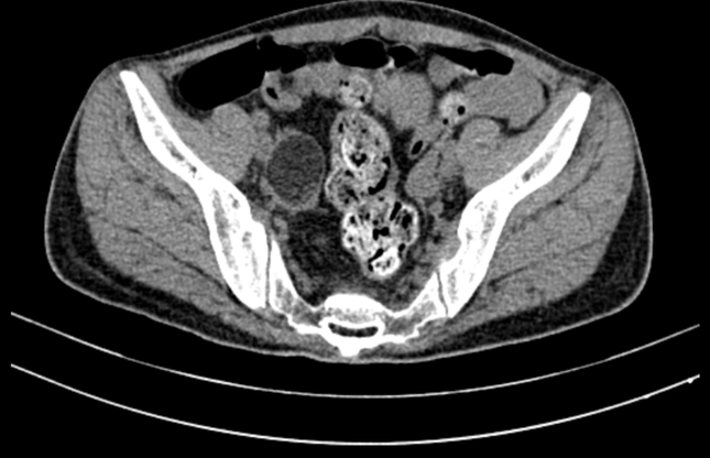 Hình ảnh khối u quái buồng trứng bên phải - nguyên nhân gây bệnh lý viêm não tự miễn cho bệnh nhân (ảnh: BVCC)