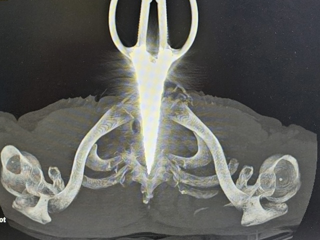 Sức khỏe đời sống - Người đàn ông nhập viện với chiếc kéo đâm xuyên cổ