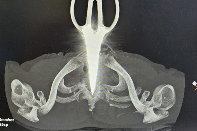 Hình ảnh cây kéo đâm xuyên cổ bệnh nhân, qua chụp cắt lớp vi tính. Ảnh: Thanh Phong