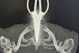 Sức khỏe đời sống - Người đàn ông nhập viện với chiếc kéo đâm xuyên cổ