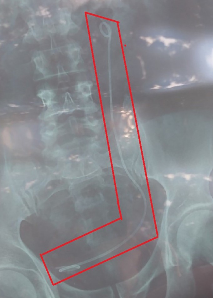 Phim X-quang có dị vật (vùng khoanh đỏ) ghi tên bệnh nhân Hải thực chất hình ảnh là của bệnh nhân Nghĩa, dẫn đến nội soi sai người. Ảnh:Khánh Hương