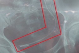 Tin tức trong ngày - Tại sao bác sĩ ở Lâm Đồng nội soi nhầm bệnh nhân?