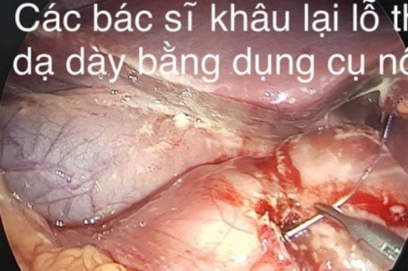Nam sinh 15 tuổi bị thủng dạ dày vì thói quen ăn đồ chua cay