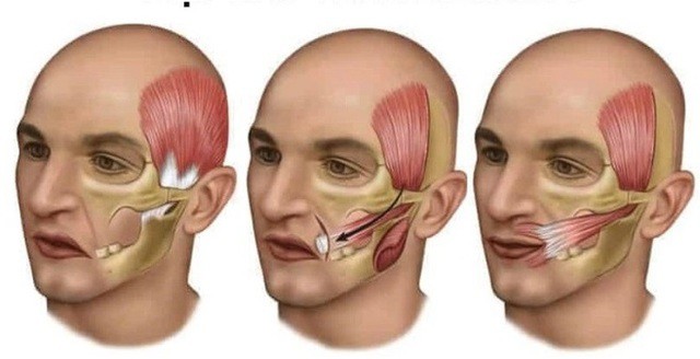 Liệt mặt nếu không được điều trị đúng cơ mặt có thể bị tổn thương và mất đi chức năng vận động. Ảnh minh họa