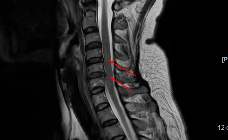 Thoát vị đĩa đệm đa tầng C3/4, C4/5, C5/6 kèm hẹp cột sống cổ và chèn ép tủy