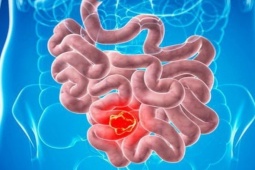 Sức khỏe đời sống - 10 dấu hiệu cho thấy ung thư ruột đang âm thầm "gõ cửa"