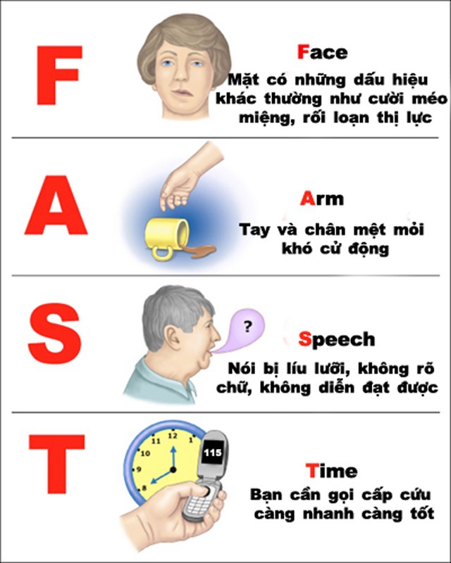 Quy tắc FAST đột quỵ giúp nhanh chóng nhận biết người có dấu hiệu đột quỵ để kịp thời cấp cứu, can thiệp.