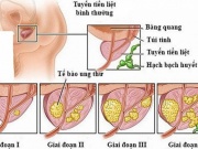 Sức khỏe đời sống - Ung thư tuyến tiền liệt sống được bao lâu?