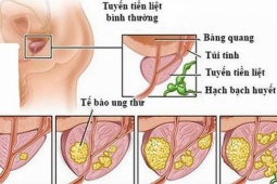 Sức khỏe đời sống - Ung thư tuyến tiền liệt sống được bao lâu?