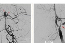 Sức khỏe đời sống - Người phụ nữ bị cùng lúc 2 dạng đột quỵ đặc biệt nguy hiểm