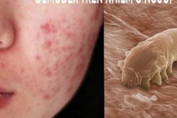 Sức khỏe đời sống - Mặt nổi mụn, sẩn đỏ, ngứa như kiến bò có thể bạn đã mắc loại ký sinh trùng nguy hiểm