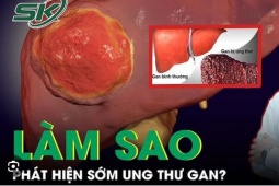 Sức khỏe đời sống - Làm sao để phát hiện sớm ung thư gan?