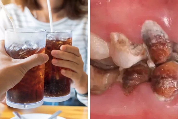 Răng của cô gái bị hư hại nghiêm trọng do uống nhiều nước ngọt.