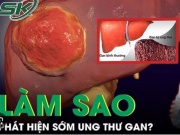 Sức khỏe đời sống - Làm sao để phát hiện sớm ung thư gan?