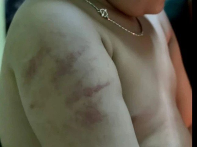 Hình ảnh bé trai ở huyện Tuy Phước có nhiều vết thương trên cánh tay được chia sẻ. Ảnh chụp màn hình