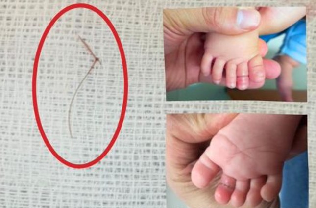 Bé gái 4 tháng tuổi may mắn giữ lại được ngón chân nhờ loại bỏ sợi tóc kịp thời