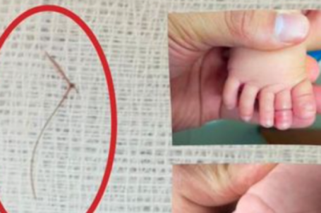 Sợi tóc thắt vào chân, bé gái 4 tháng tuổi suýt mất ngón