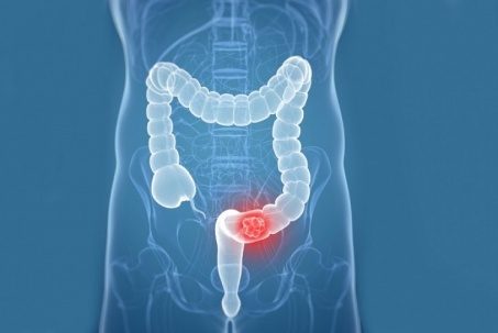 Ung thư đại tràng phổ biến top đầu thế giới, cần biết những gì để...