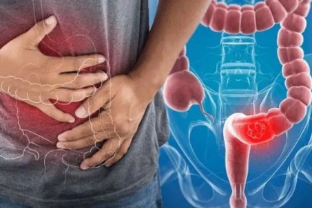 Phó Giám đốc Bệnh viện K chỉ rõ dấu hiệu nhận biết sớm ung thư trực...