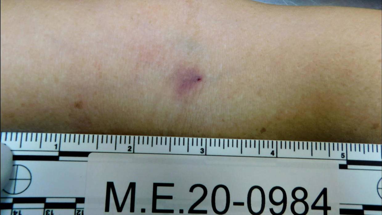 Vết kim đâm nhỏ trên cánh tay phải của Maria Munoz