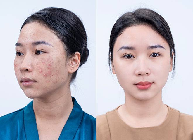 Kết quả điều trị mụn với Meso Extra không kim