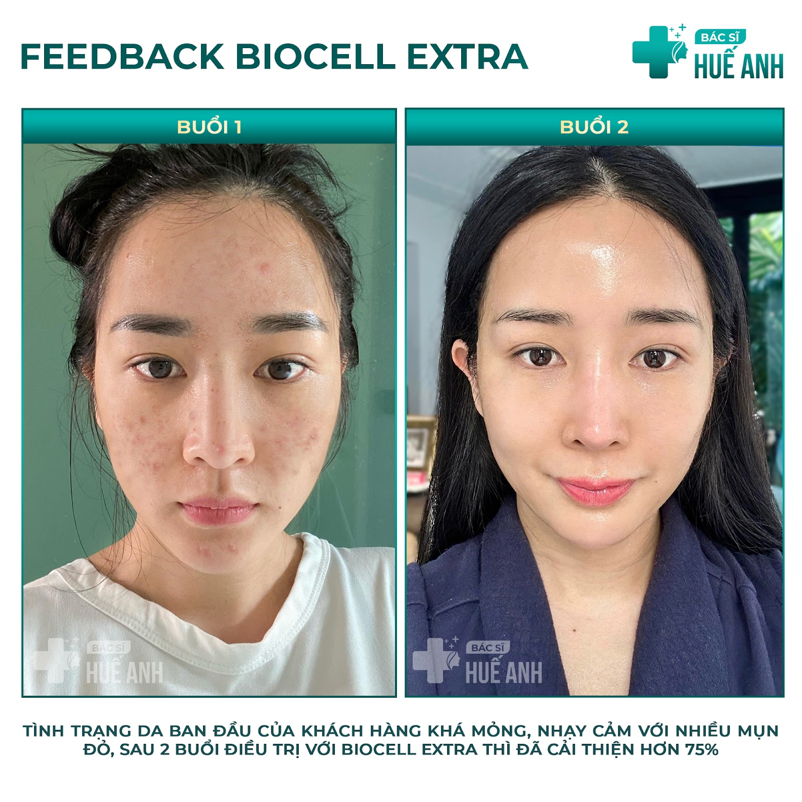 Kết quả khách hàng sau khi cấy căng bóng da Biocell Extra cùng bác sĩ Huế Anh