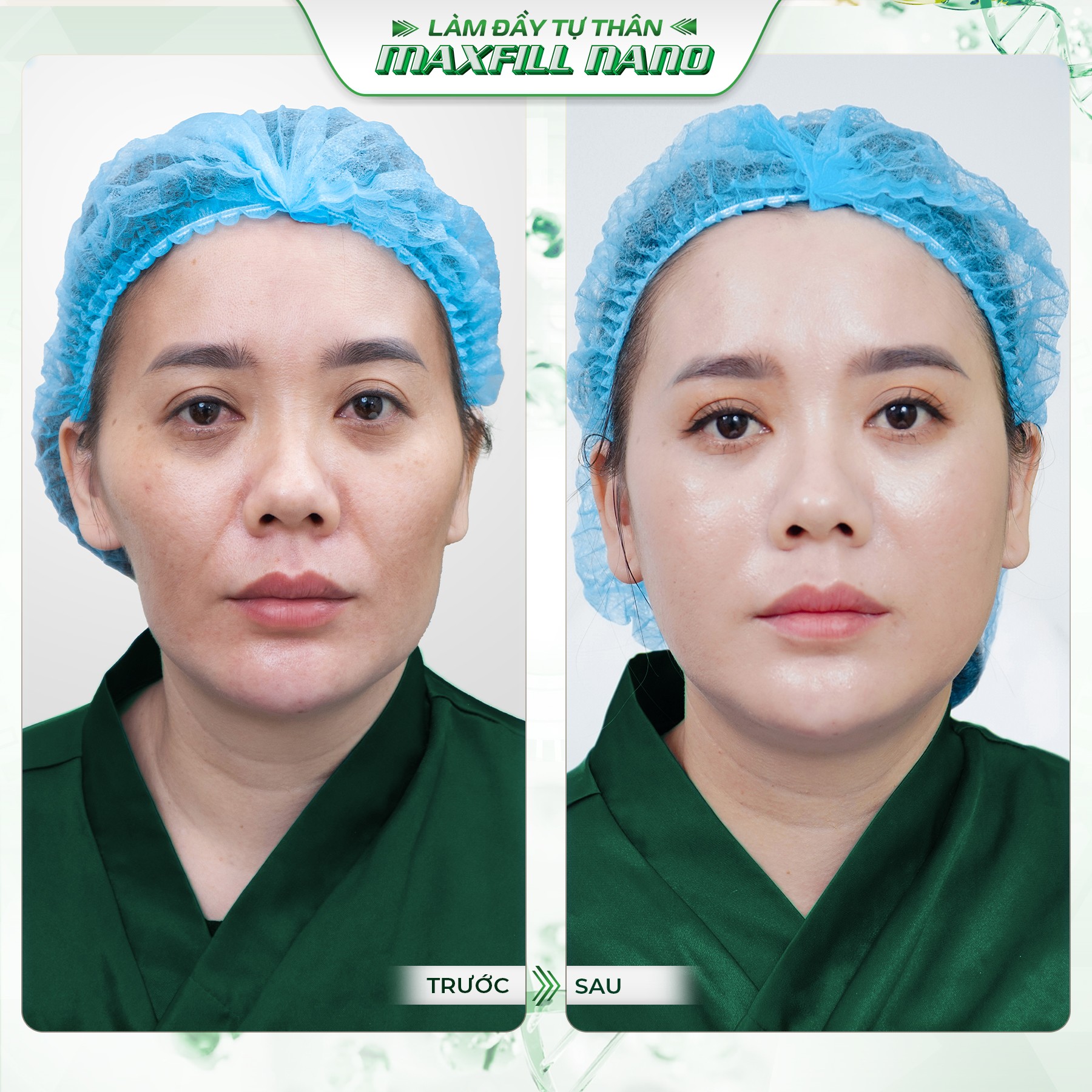 Kết quả trước - sau khách hàng thực hiện Maxfill Nano
