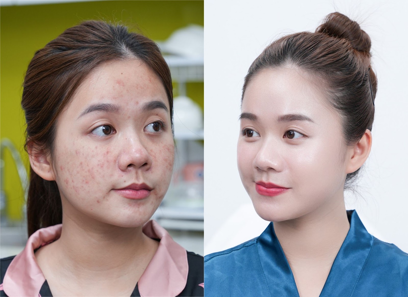 &nbsp;&nbsp;&nbsp;&nbsp;&nbsp;&nbsp;&nbsp;&nbsp;Hình ảnh trước sau của khách hàng khi điều trị bằng Meso Extra không kim&nbsp;