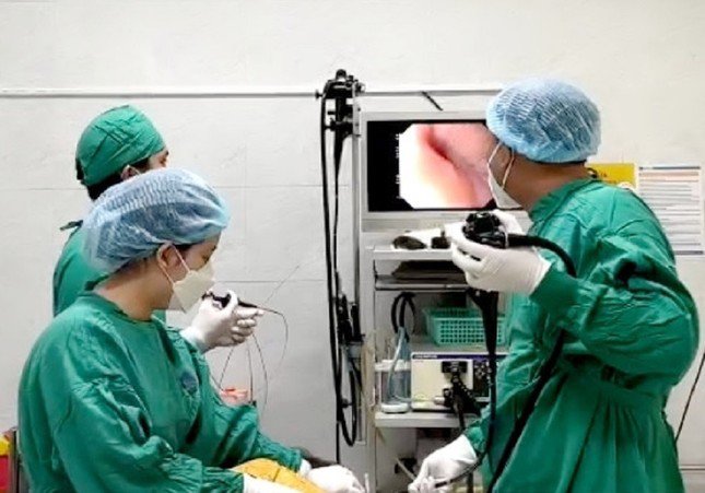 Các bác sĩ tiến hành nội soi gắp dị vật là chiếc tăm tre trong dạ dày của bệnh nhân