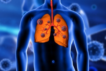 Ung thư phổi phổ biến hàng đầu trên thế giới và Việt Nam, biết những điều này để phòng tránh