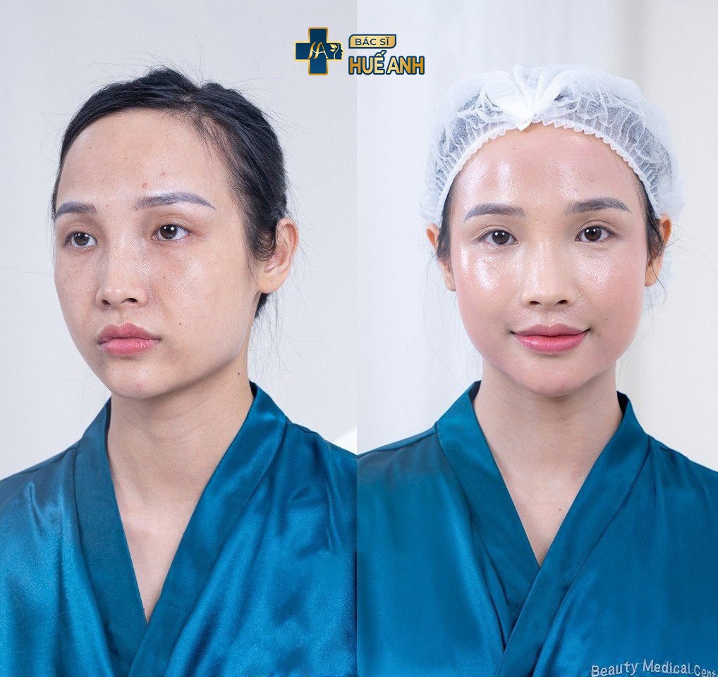 Kết quả khách hàng thực hiện trẻ hóa