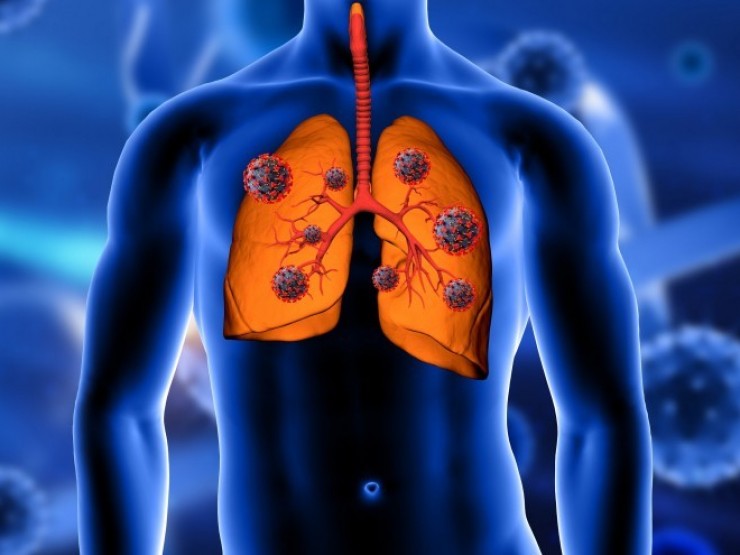 Đừng dại hiểu sai những điều này về ung thư phổi kẻo “hối không kịp“
