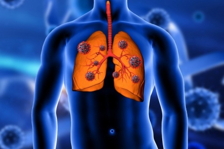 Đừng dại hiểu sai những điều này về ung thư phổi kẻo "hối không kịp"