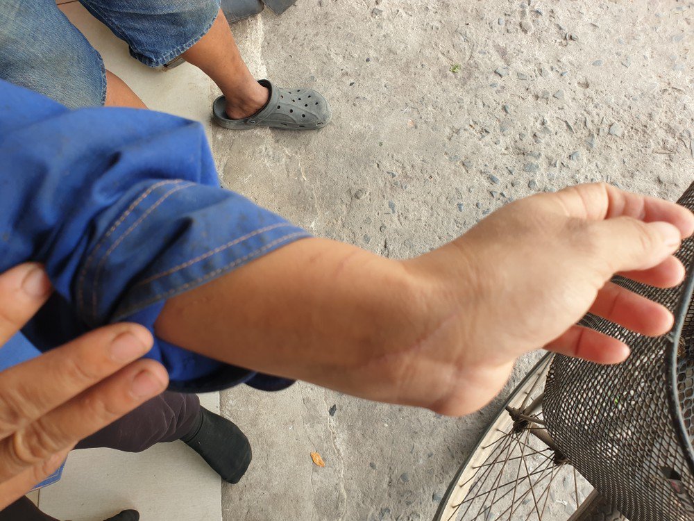 Ngoài ra, vợ của anh Cảnh cũng bị khỉ cào cấu, xước tay. Ảnh: NT