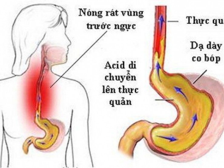 Người phụ nữ 30 tuổi bị loét hoàn toàn thực quản vì một sai lầm nhiều người Việt mắc phải khi uống thuốc