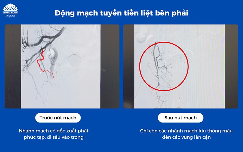 Hình ảnh động mạch tuyến tiền liệt bên phải trước và sau khi can thiệp