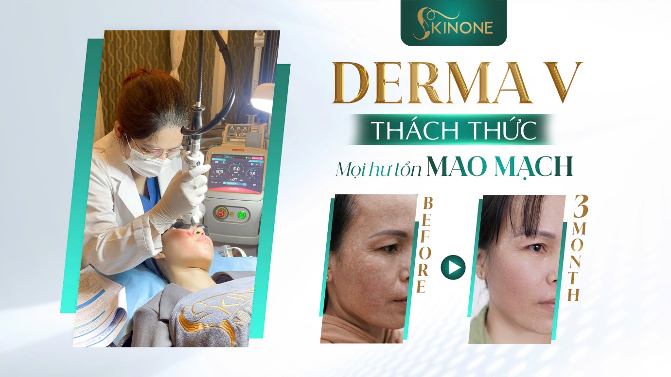 Derma V được coi là một trong những công nghệ hiện đại trong về điều trị mao mạch.
