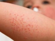 Sức khỏe đời sống - Bệnh sởi có dấu hiệu gia tăng dịp Tết, chăm sóc trẻ mắc bệnh tại nhà như thế nào?