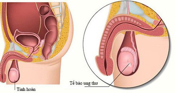 Ung thư tinh hoàn hiếm gặp nhưng có thể tiến triển nhanh chóng và nguy hiểm. Ảnh minh họa.