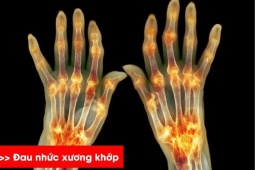 Tin tức sức khỏe - Sưng đau nhiều khớp chân tay - người phụ nữ Đồng Nai bất ngờ khi biết mắc bệnh xương khớp!