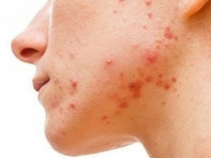 Cảnh báo mụn có thể là dấu hiệu của bệnh thận giai đoạn cuối