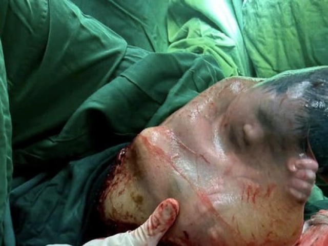 Bé trai “đẻ bọc điều“, 80.000 ca mới có một