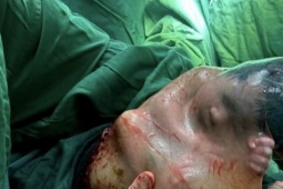 Bé trai 'đẻ bọc điều', 80.000 ca mới có một