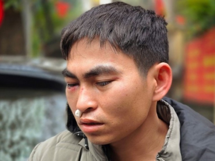 Nam shipper bị hành hung: “Tôi còn đau đầu, đang được công an đưa đi giám định“
